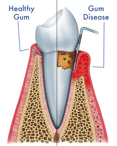 healthy gum disese gum
