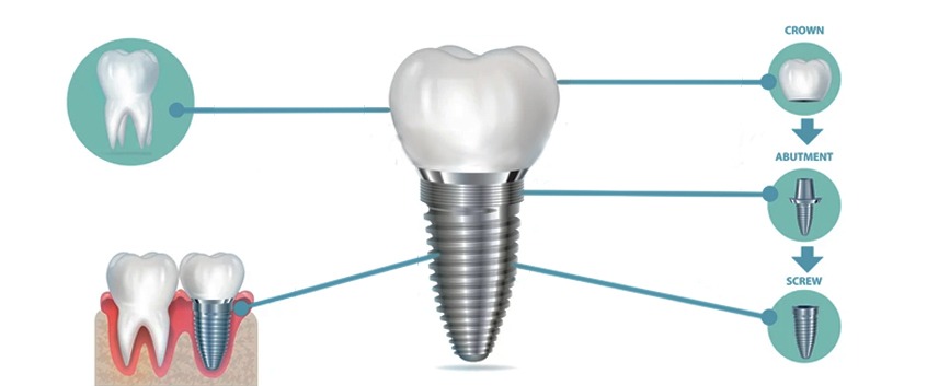 implants blog Implant post 2