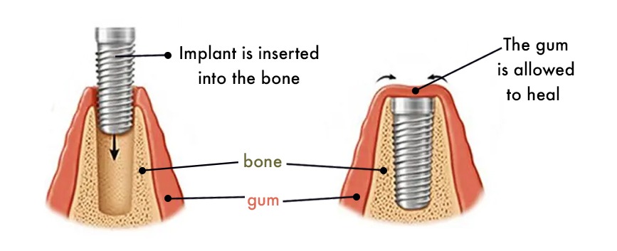 implants blog Implant procedure 1