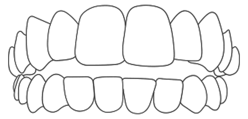 Invisalign Solution for Open Bite Image Dental Clinic London