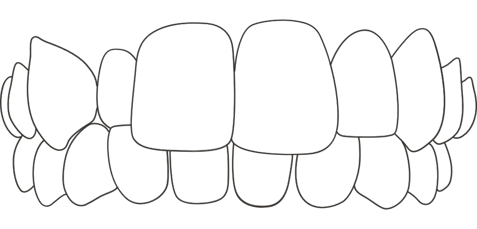 Invisalign for Cross Bite Image Dental Clinic London