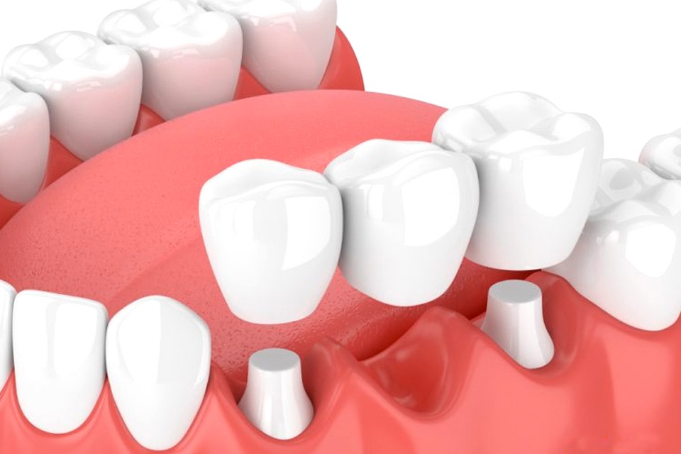 dental bridge image
