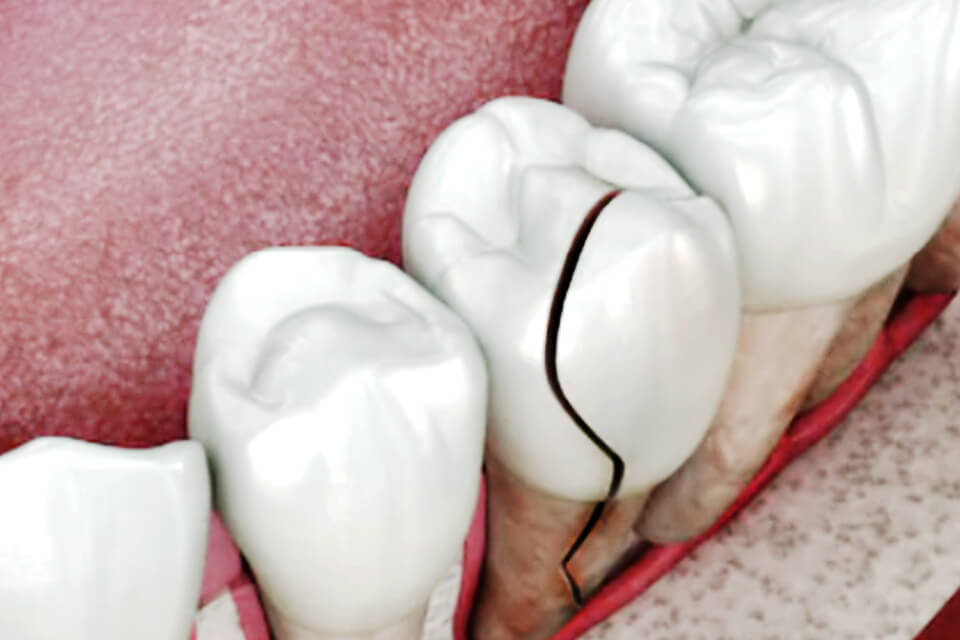 cracked tooth image for header