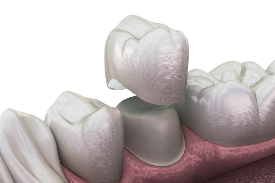 dental Crowns image