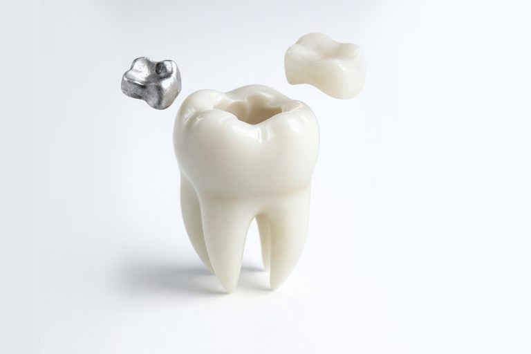 Silver Vs. White Dental Filling – Which Is Better?