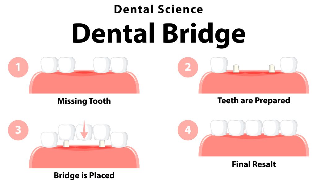Dental Bridges in Ilford, Essex 2 dental bridges process