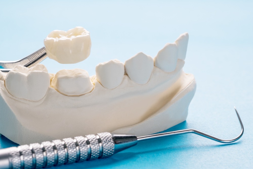 Dental Crowns in Ilford, Essex 2 dental cown presentation