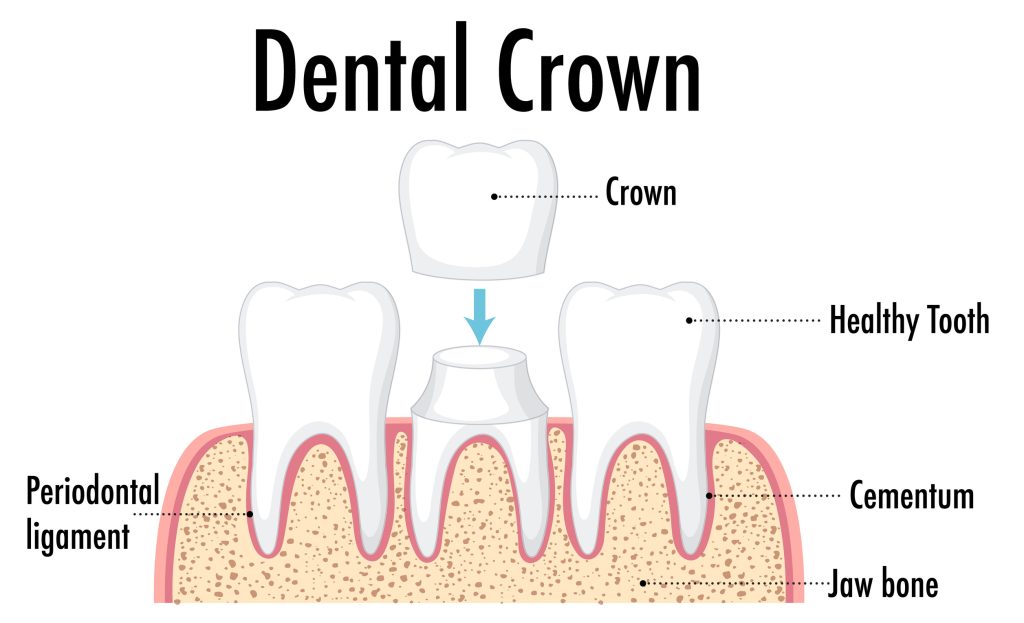 Dental Crowns in Ilford, Essex 1 dental crown illustration