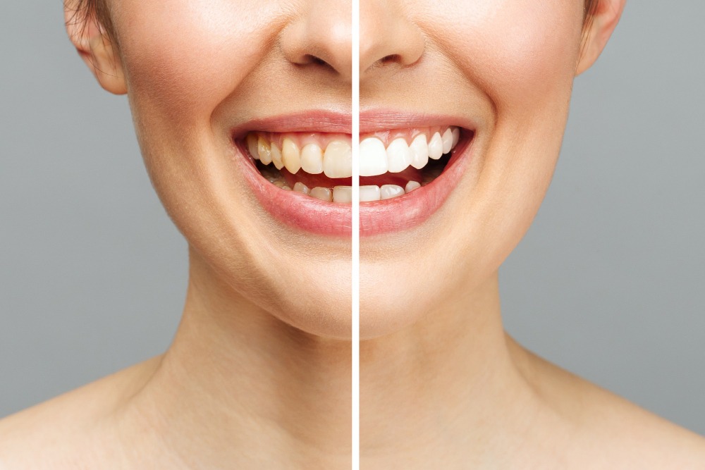 Teeth Whitening in Ilford, Essex 8 woman showing before and after teeth whitening