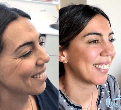 Teeth Whitening in Ilford, Essex 5 before and after teeth whitening at longwood house dental care in ilford essex
