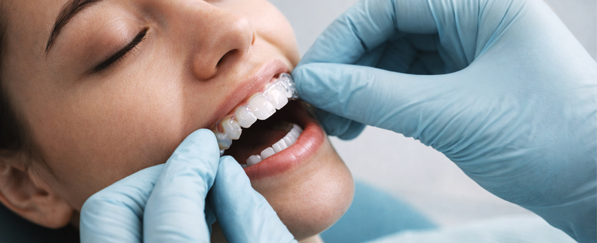 Invisalig overbite 2