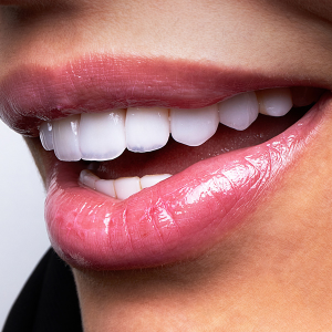 Composite Bonding 2 composite bonding 1